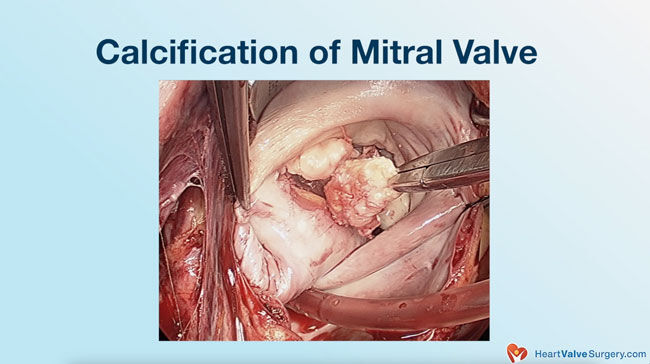 Mitral Valve Calcification in Operating Room