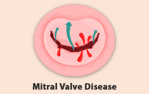 Mitral Valve Disease