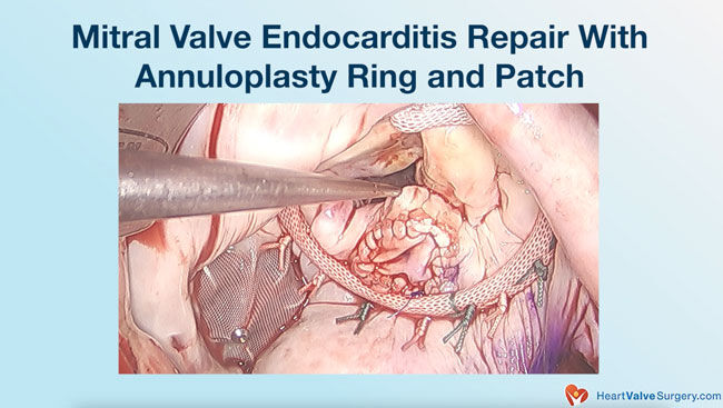 Mitral valve endocarditis repair annuloplasty patch