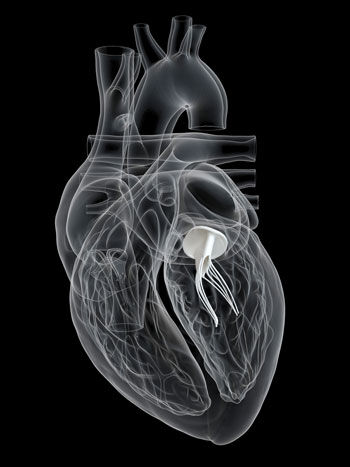 Mitral Valve Illustration