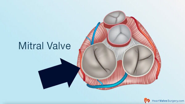 Leaking Mitral Valve Due to Atrial Fibrillation