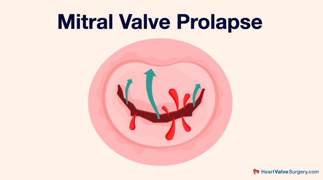 Mitral Valve Prolapse Diagram