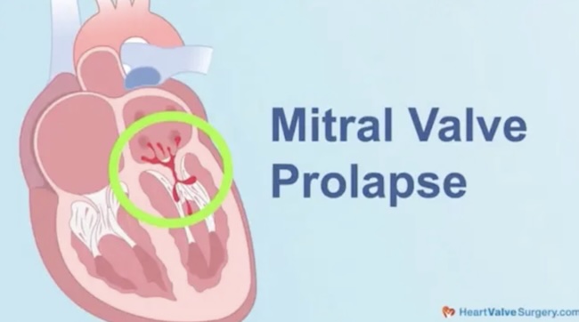 Mitral Valve Prolapse Drawing