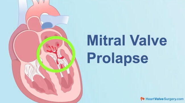 Mitral Valve Prolapse Drawing
