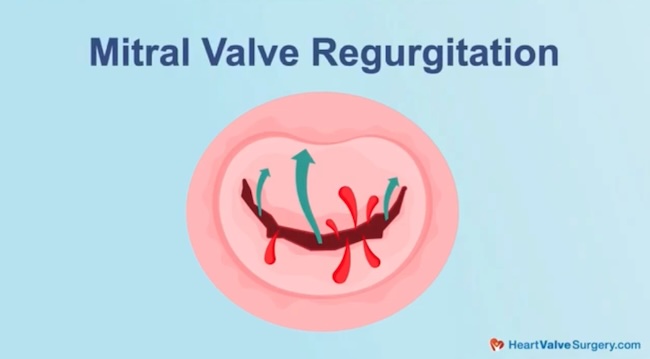 Mitral Regurgitation Drawing