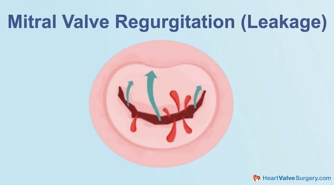 Mitral Valve Regurgitation