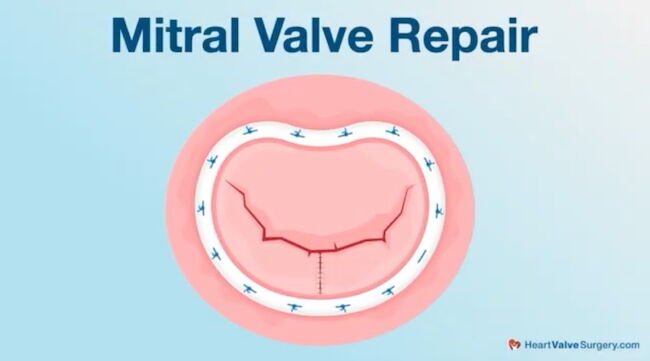Mitral Valve Repair Drawing
