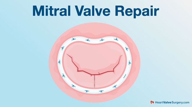 Mitral Valve Repair Diagram