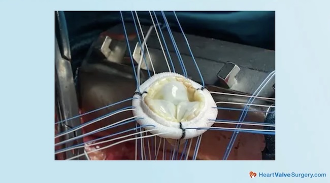 Mitral Valve Repair Stitches