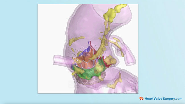 Neo Sinus TAVR