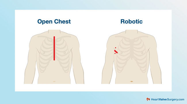 Open Heart Robotic Diagram Incision