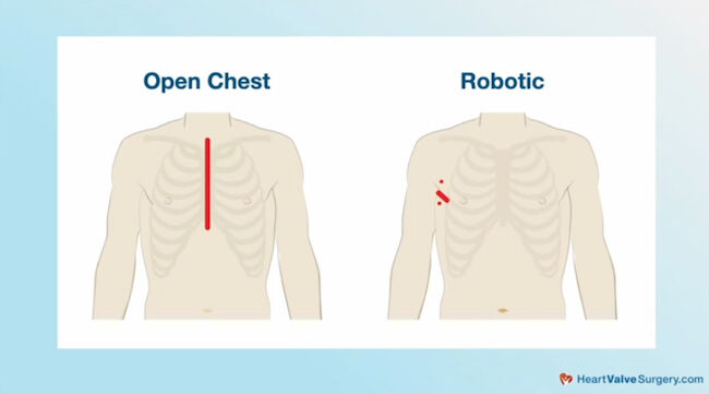 Open Heart Versus Robotic Incision