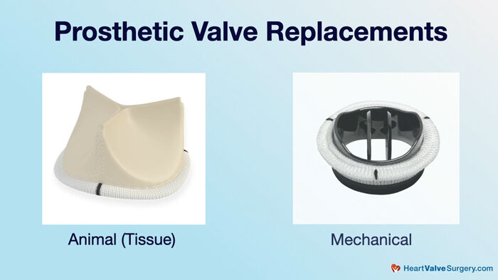 Prosthetic Heart Valve Replacement