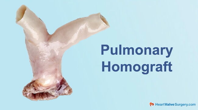 Pulmonary Homograft from Artivion