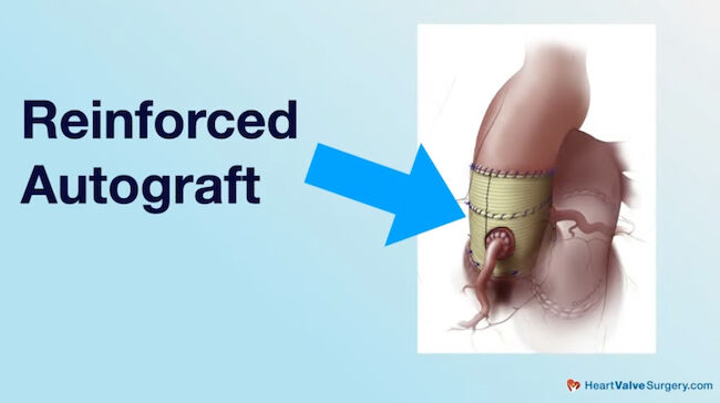 Reinforced Pulmonary Autograft