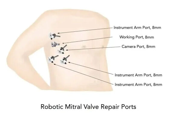Robotic Mitral Valve Repair Ports