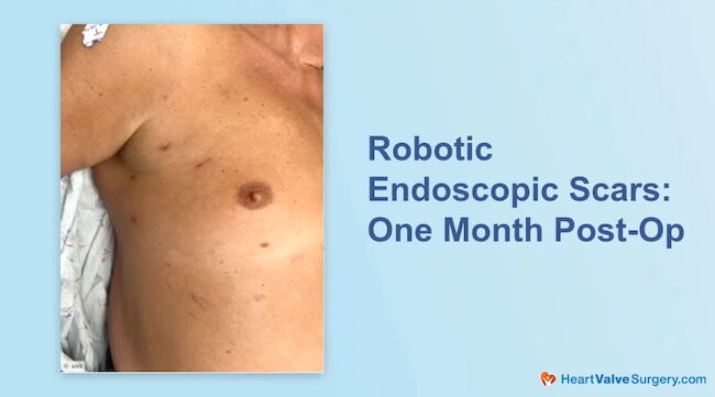 Minimal Scars from Robotic Mitral Valve Surgery