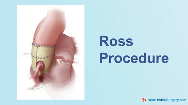 Ross Procedure Drawing