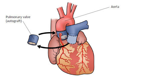 Ross Procedure