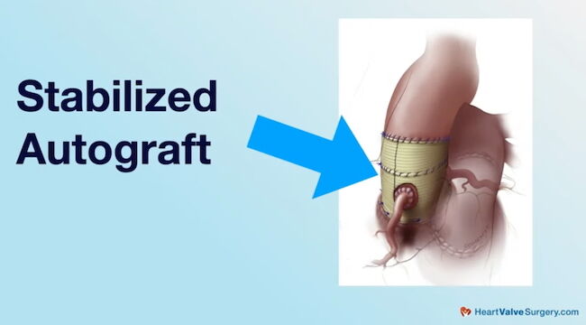 Stablized Autograft After Ross Procedure