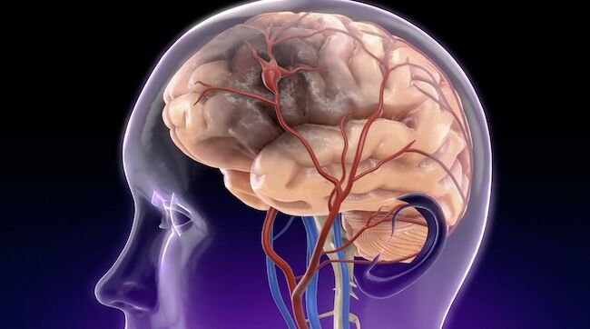 Stroke Risk Drawing