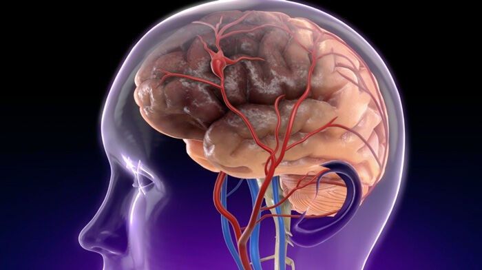 Stroke Risk & Heart Valve Calcifcation