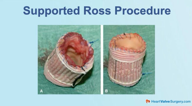Supported Ross Procedure
