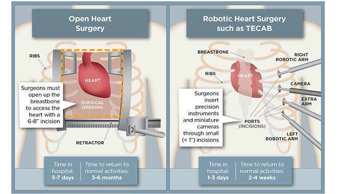 Totally Endoscopic Coronary Artery Bypass