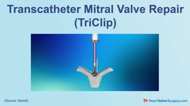 TriClip Device Tricuspid Valve
