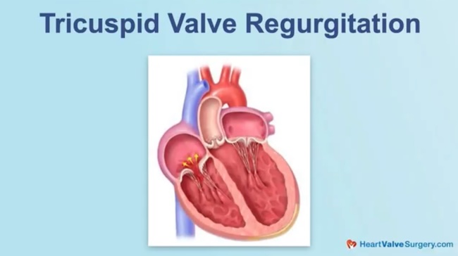 Tricuspid Valve Regurgitation Drawing