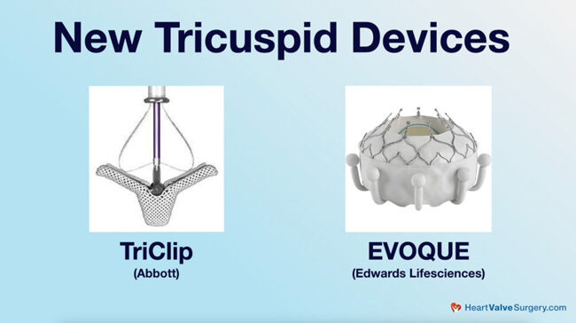 Tricuspid Valve Transcatheter Devices