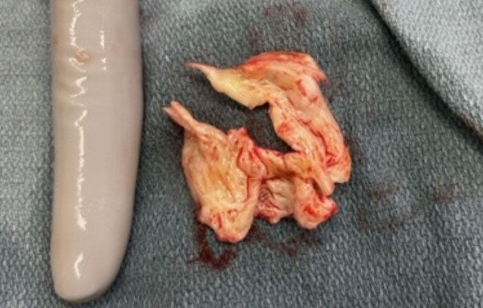 Unicuspid Aortic Valve