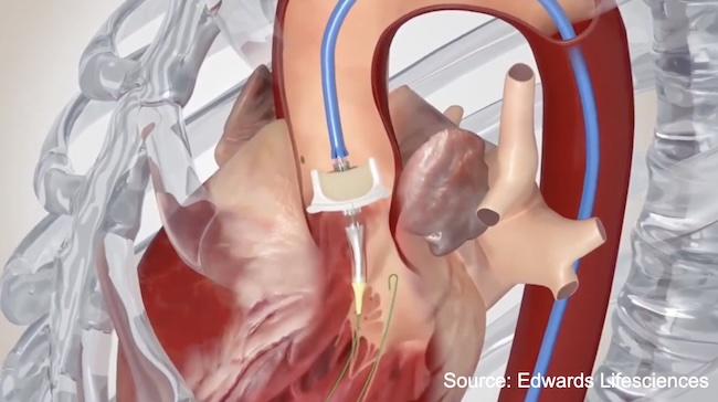 Valve-in-Valve Drawing