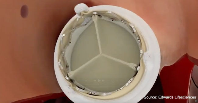 Valve in Valve Aortic Valve Replacement Using TAVR