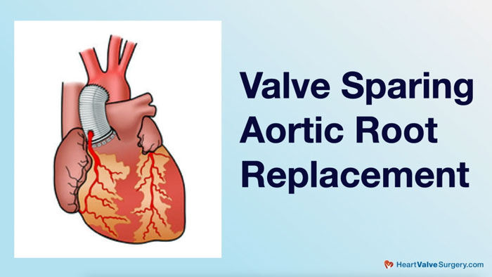 Valve Sparing Aortic Valve Root Replacement