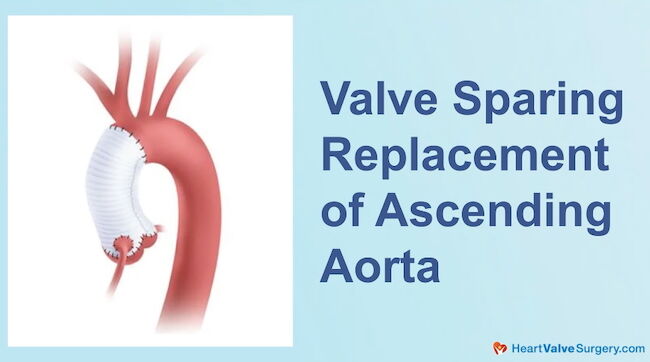 Valve Sparing Replacement of Ascending Aorta