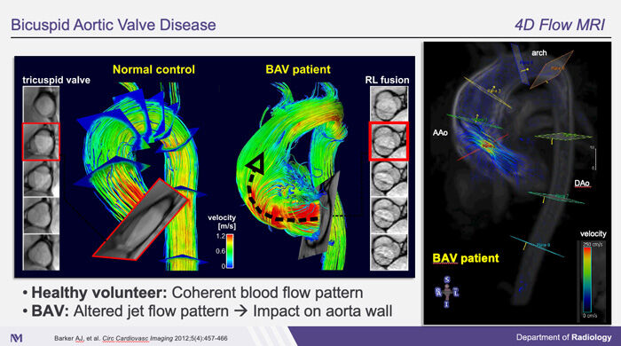 4D Flow MRI - Bicuspid Aortic Valve Wall Shear Stress