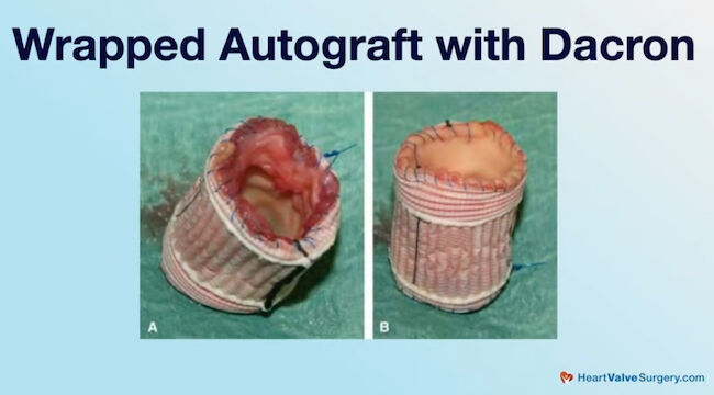 Wrapped Autograft with Dacron