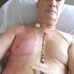 Peter Matthews, heart valve patient