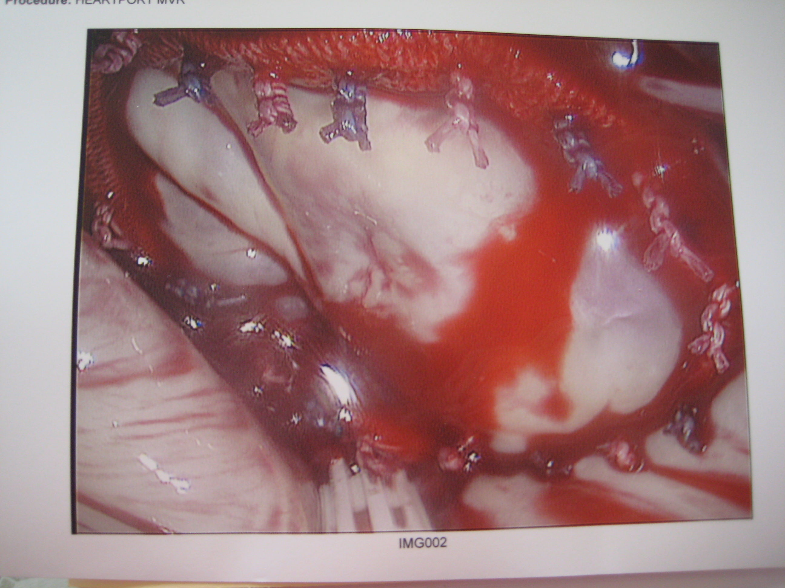 After 38MM ring insertion