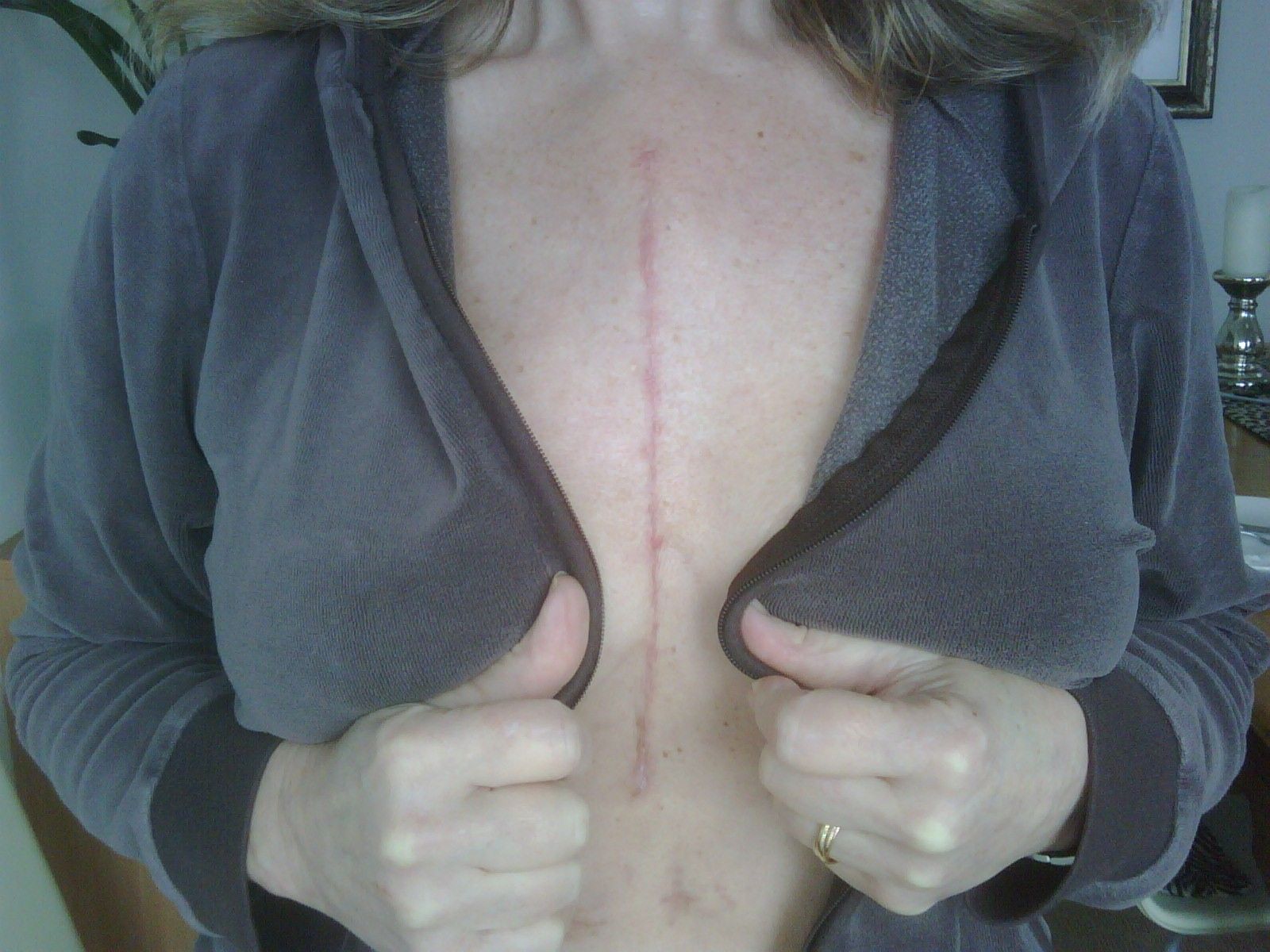 Penny's chest scars after heart surgery via sternotomy