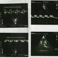 Mohammed Abdulrahman - Heart Valve Patient