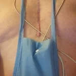 STEPHEN MORRIS, heart valve patient