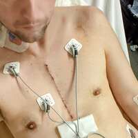 Garrett Payment - Heart Valve Patient
