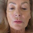 Peggy  Denham  - Heart Valve Patient