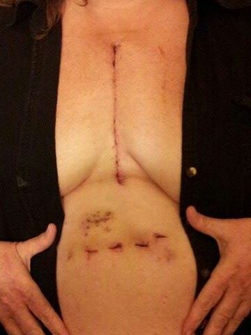 this pic is six days after my second OHS surgery in feb 2015 where I had aortic valve replaced