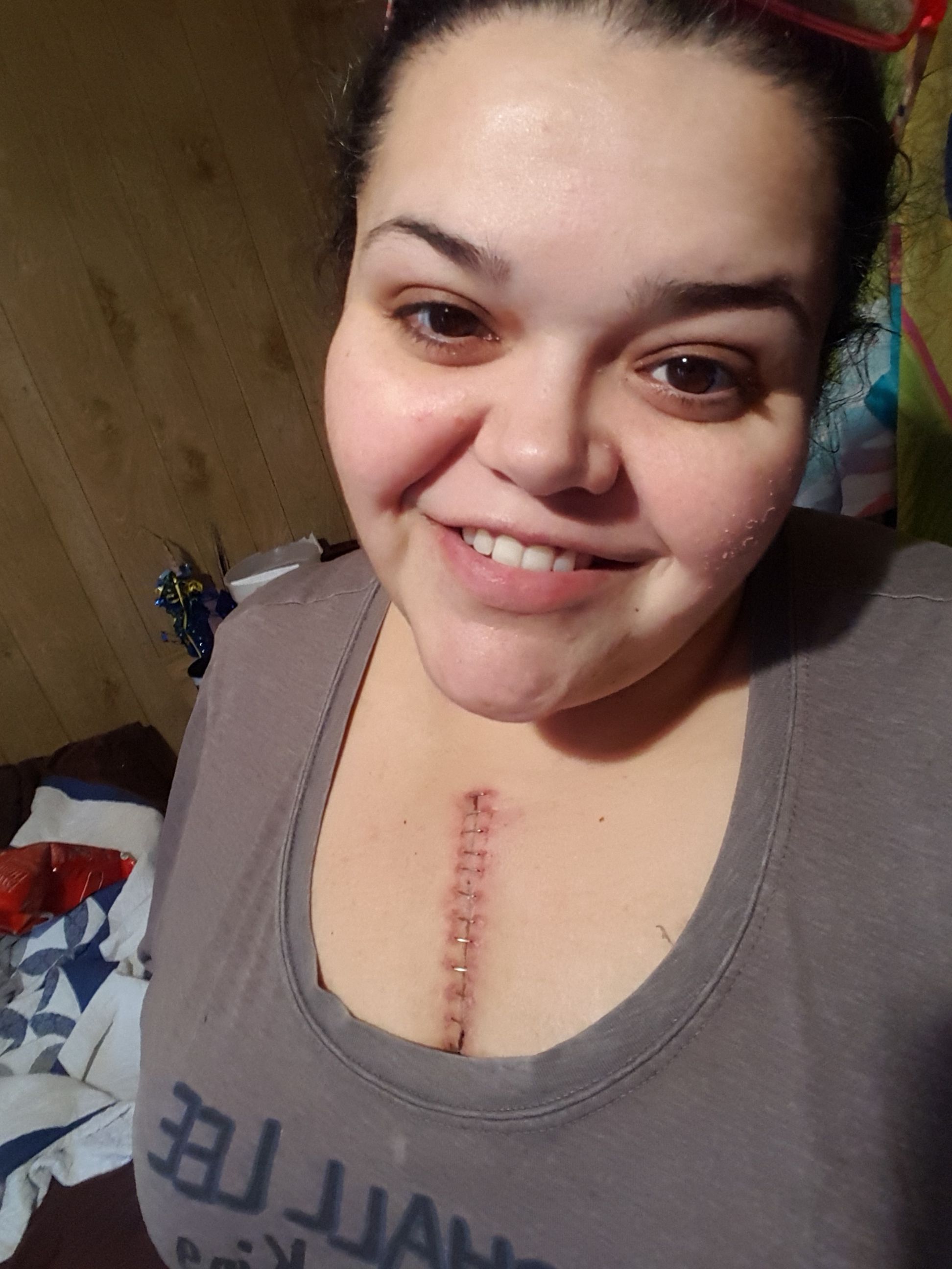 2 weeks after surgery and a week of being home I was pretty happy!