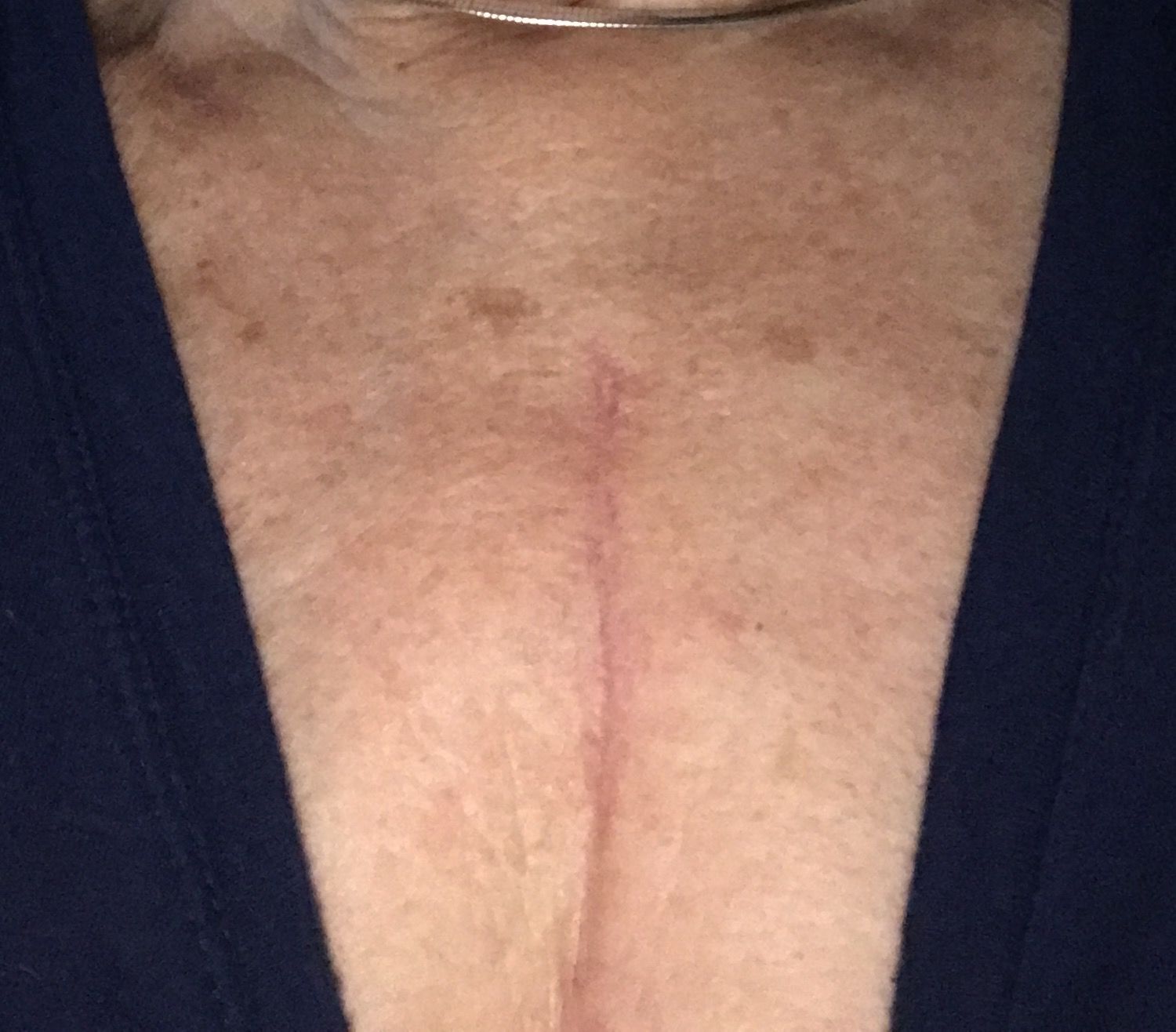 Scar at three months