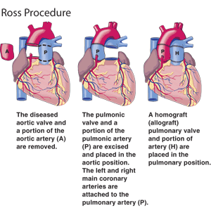 Surgical Steps Of The Ross Procedure