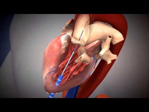 SAPIEN TAVR Deployment Animation Using Transapical Approach